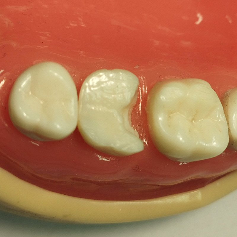Modelo dentário com margem cervical abaixo do nível gengival e caixa proximal aberta.